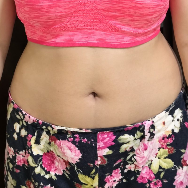 Weight wellness programme progress at day 0 — waistline before starting care at HIRAYA Lifestyle Clinic